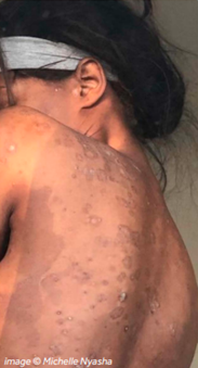 Black Skin and Psoriasis